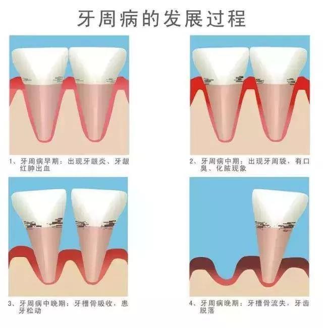 AVECMOI:牙周炎反復不見好 也許你需要益生菌來幫你